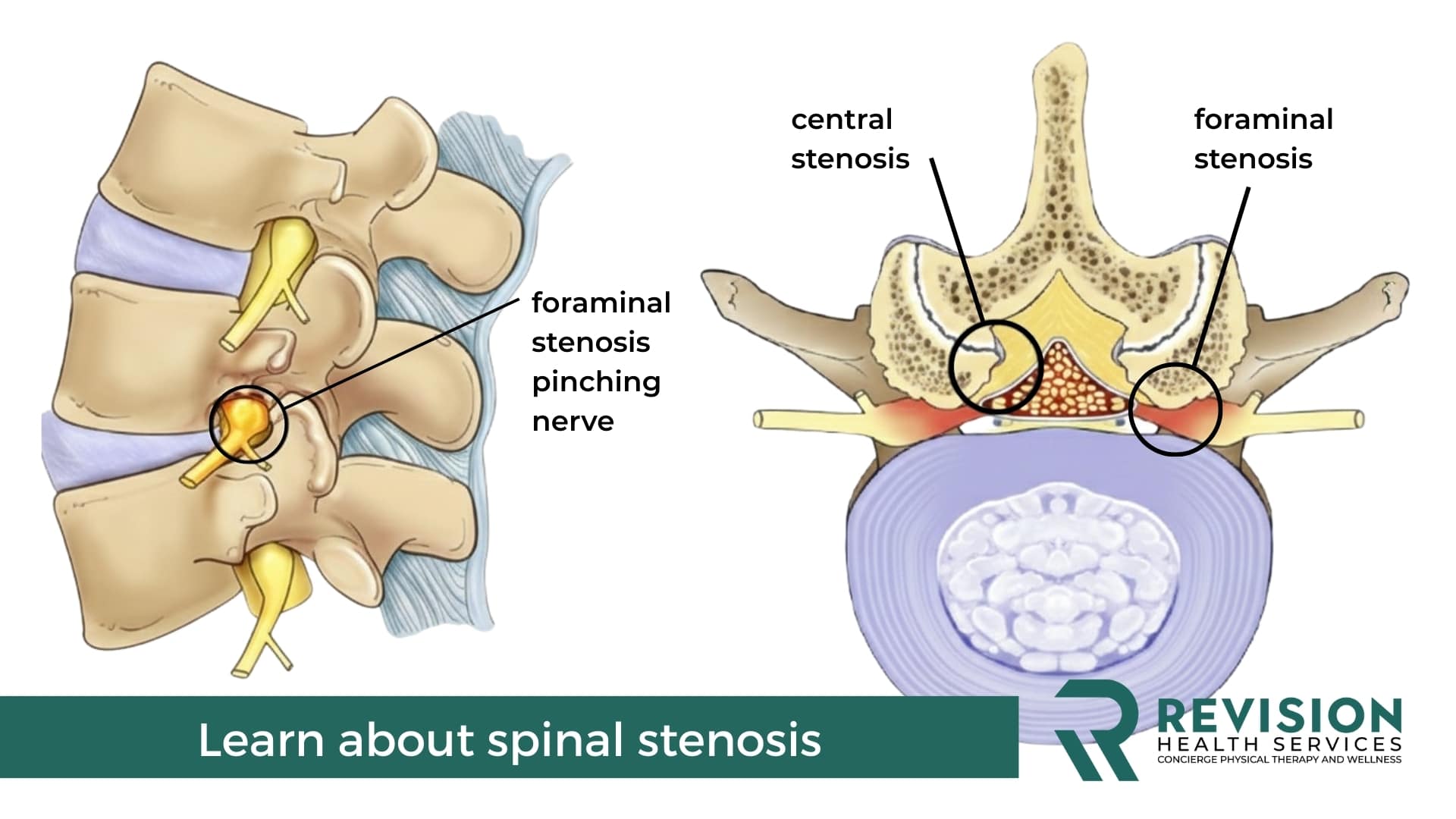 Spinal Stenosis Picture Central and Lateral