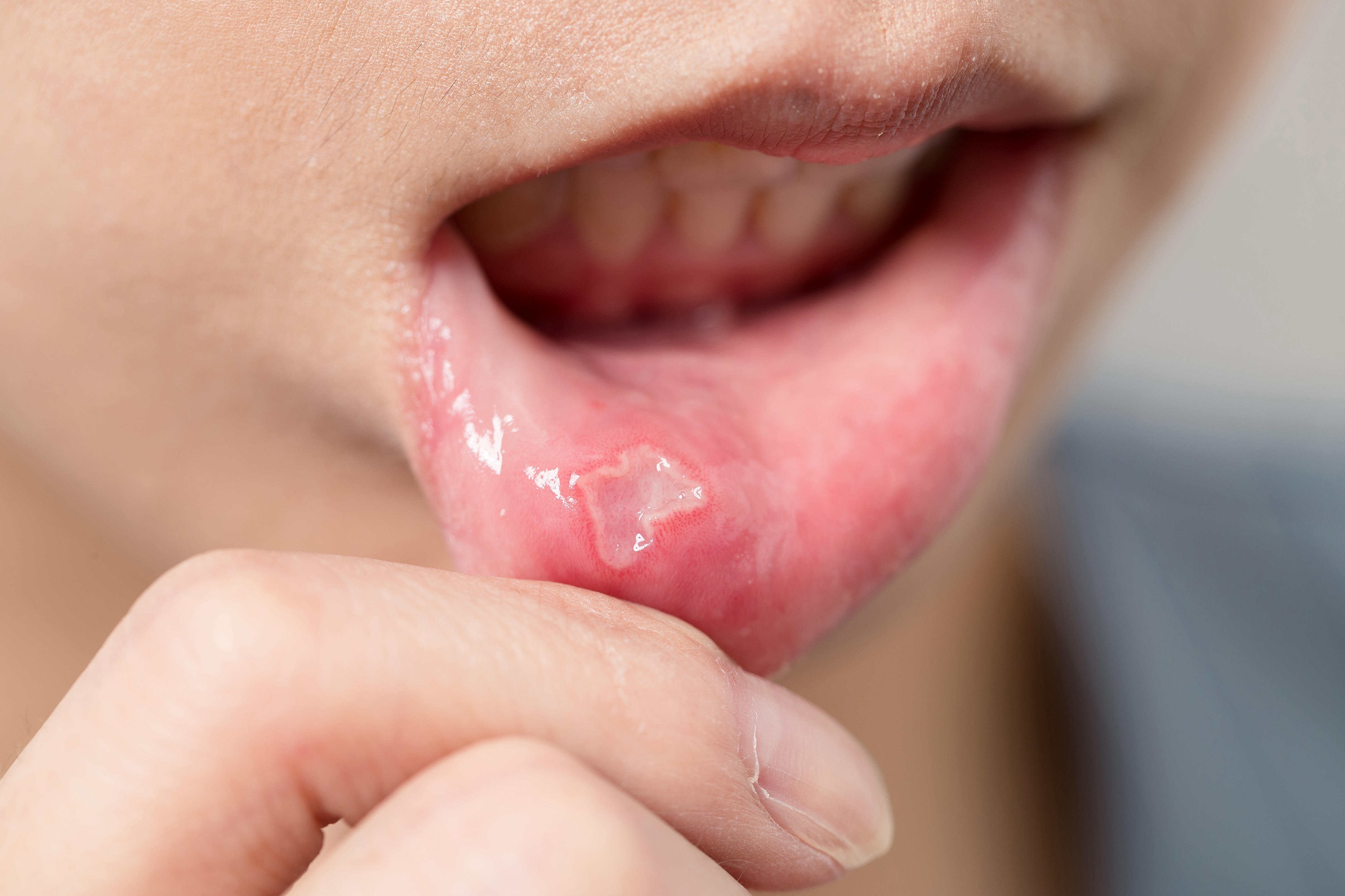 Canker Sores Mouth Ulcers Can Be Irritating In Your Mouth