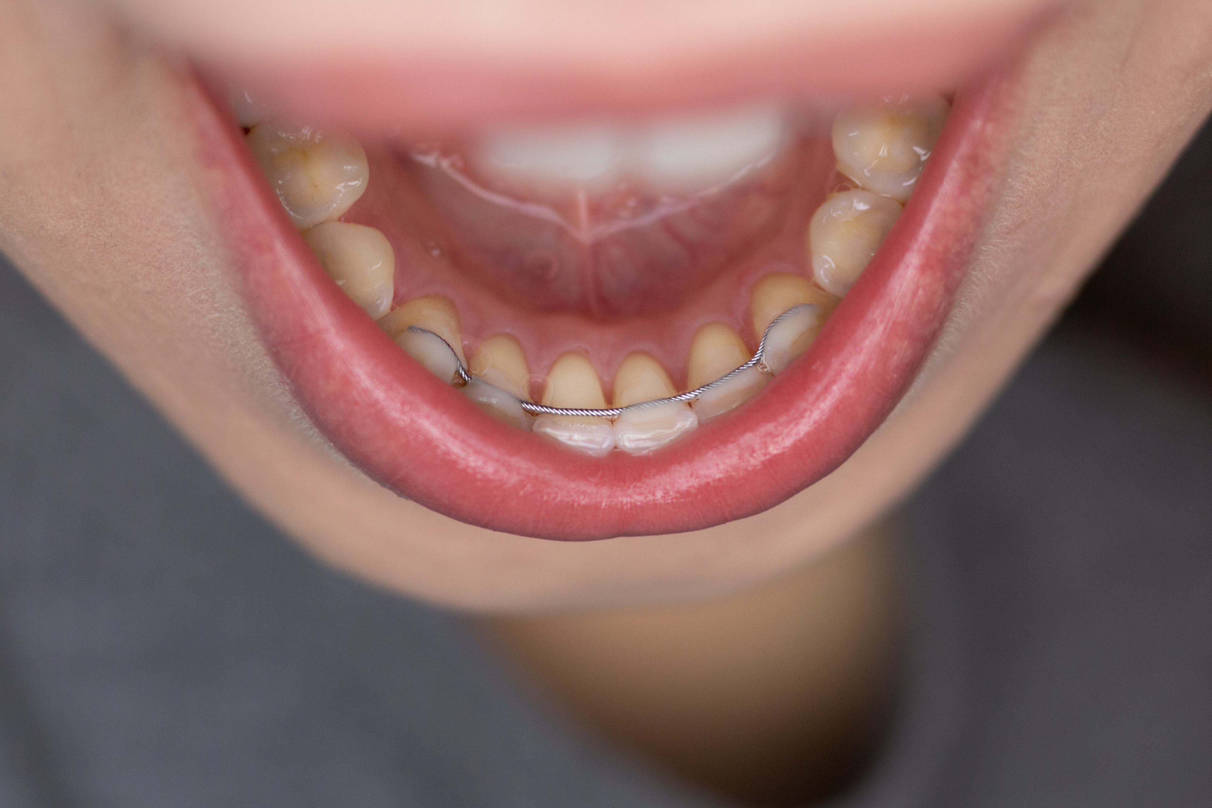 Bonded Retainer