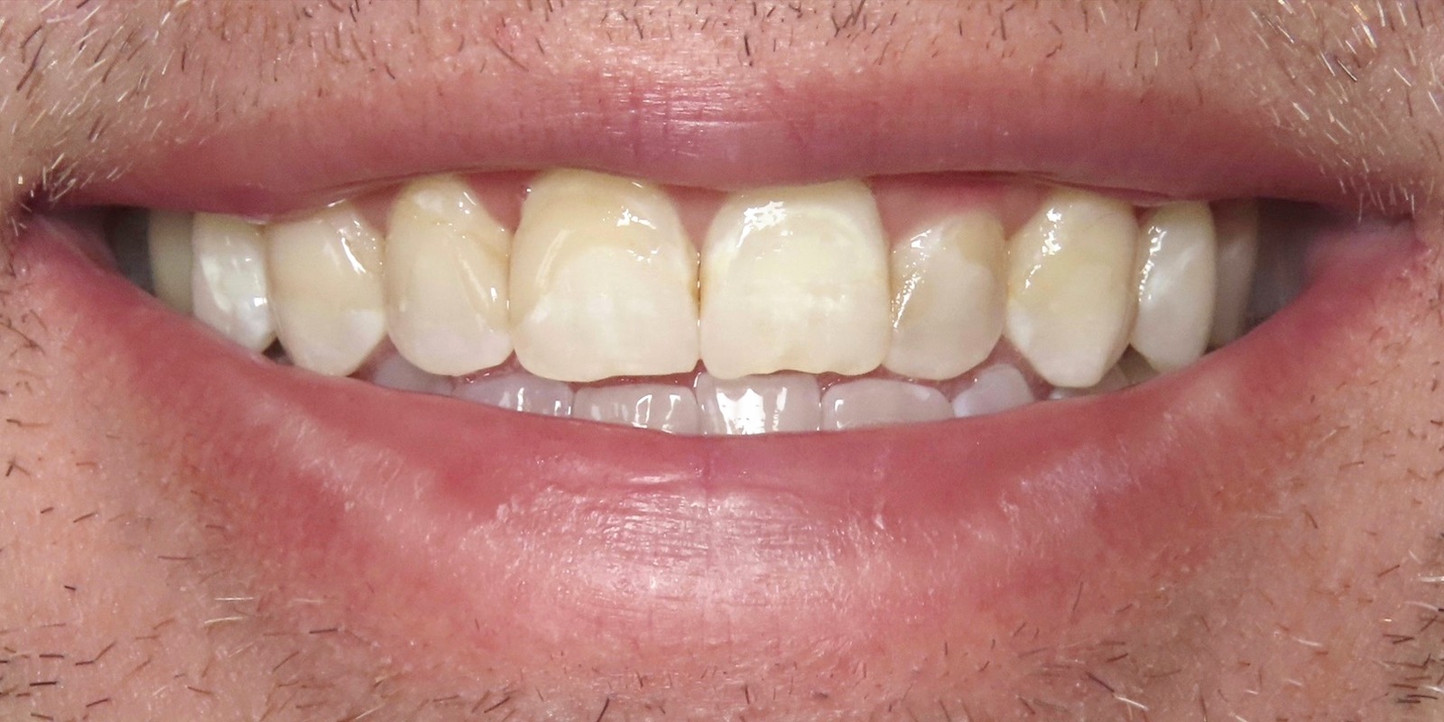 Case 5 before treatment at Trident Smiles Dental in Sunnyvale, CA