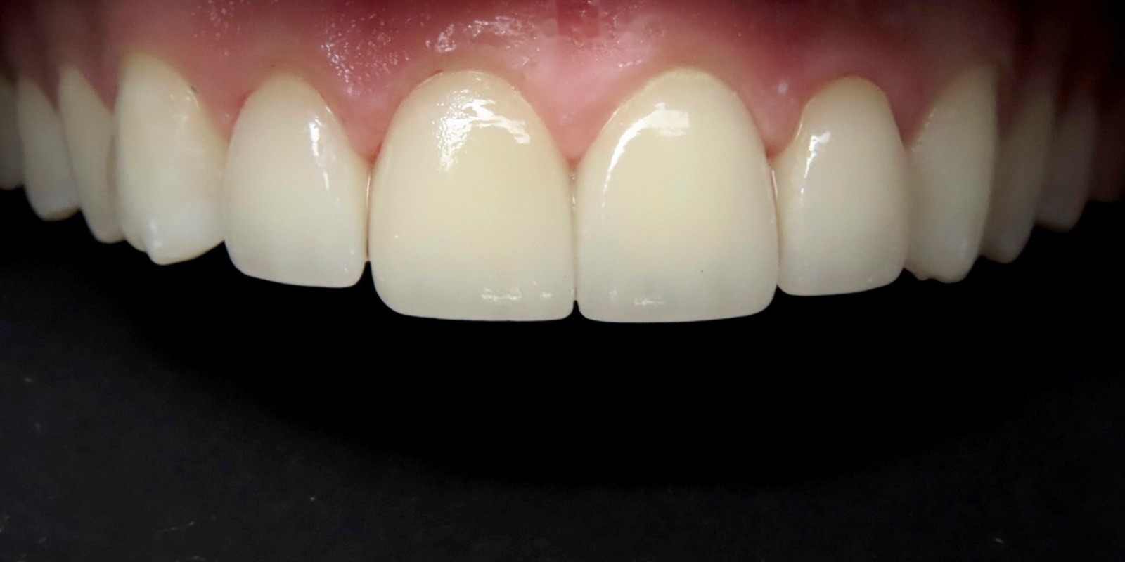 Case 8 after treatment at Trident Smiles Dental in Sunnyvale, CA
