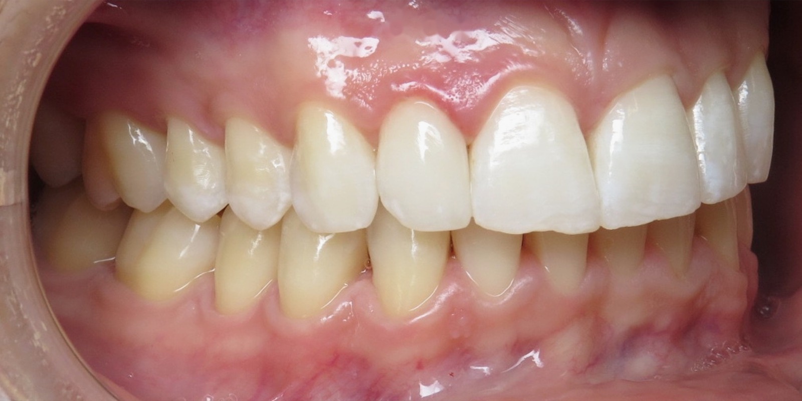 Case 12 after treatment at Trident Smiles Dental in Sunnyvale, CA