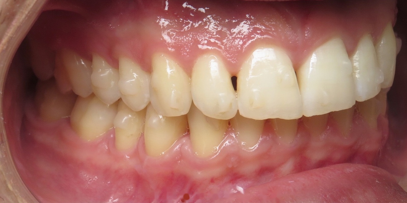 Case 12 before treatment at Trident Smiles Dental in Sunnyvale, CA