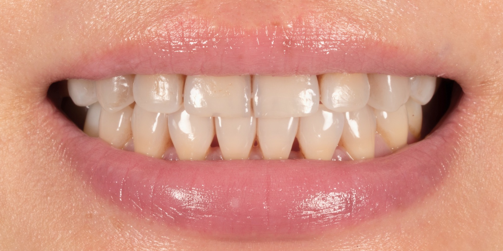 Case 18 before treatment at Trident Smiles Dental in Sunnyvale, CA
