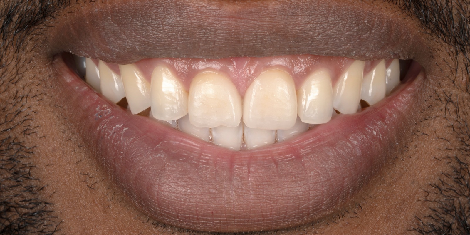 Case 20 before treatment at Trident Smiles Dental in Sunnyvale, CA