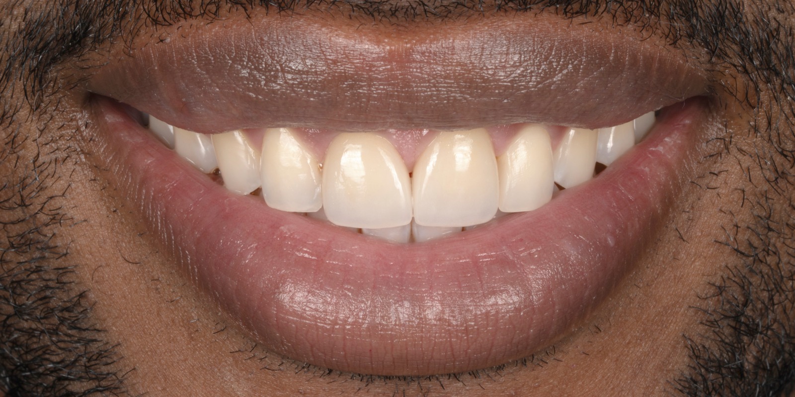 Case 20 after treatment at Trident Smiles Dental in Sunnyvale, CA
