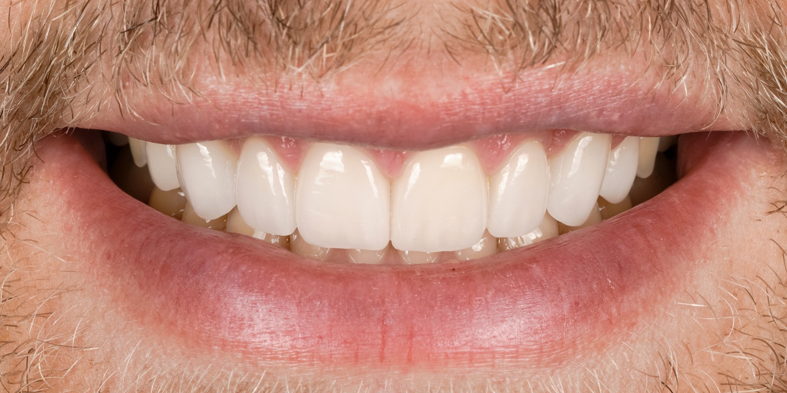 Case 19 after treatment at Trident Smiles Dental in Sunnyvale, CA