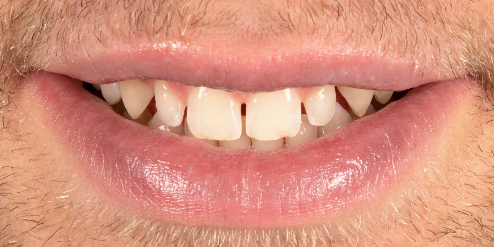 Case 19 before treatment at Trident Smiles Dental in Sunnyvale, CA