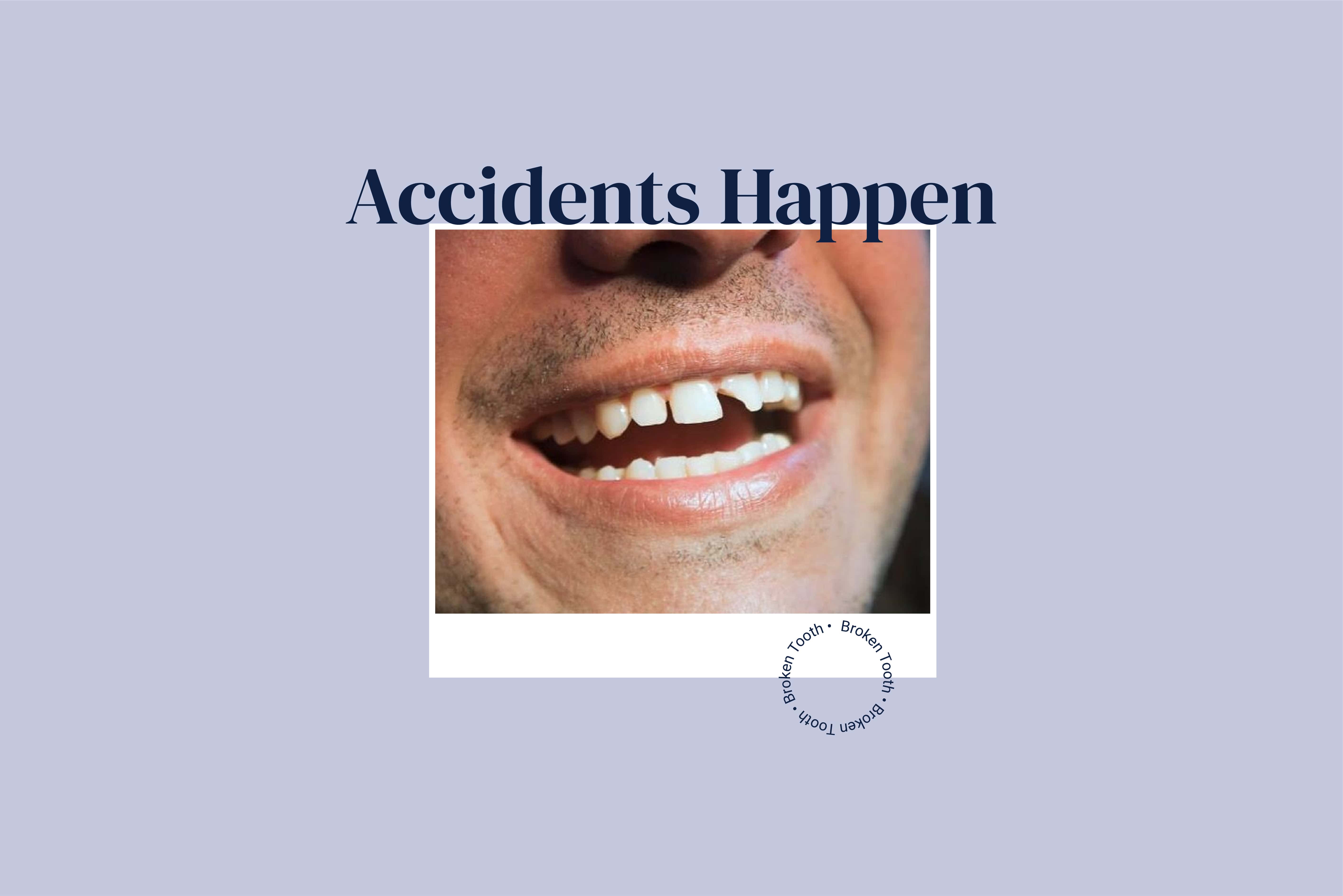 cracked tooth