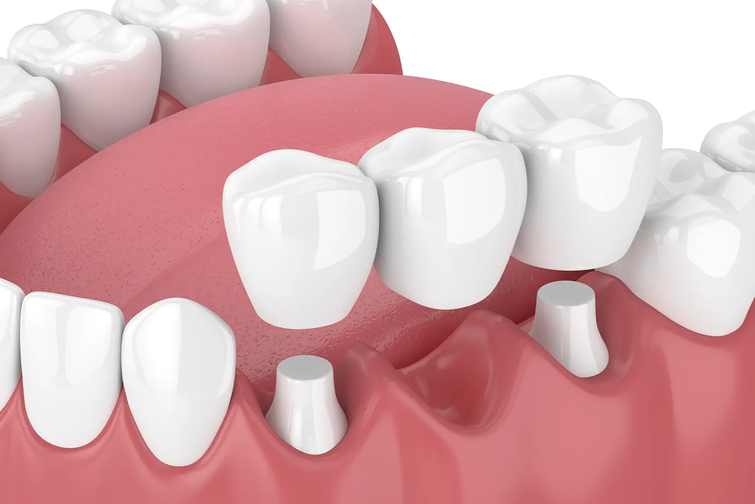 Dental Bridges: Mastering the Best Techniques for Flossing and Cleaning