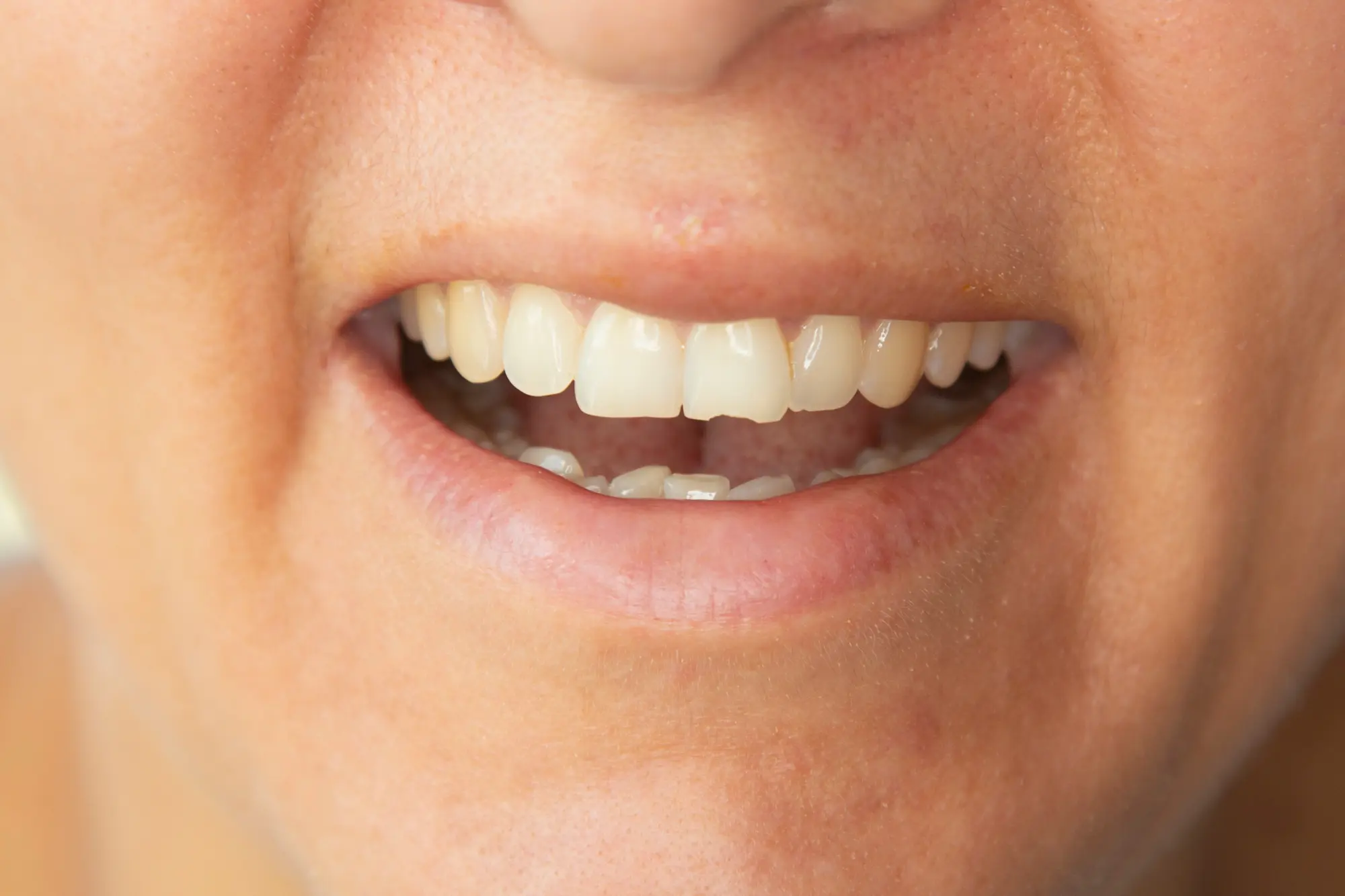 Cracked Tooth vs. Chipped Tooth: When Do You Need a Same-Day Dental Crown?