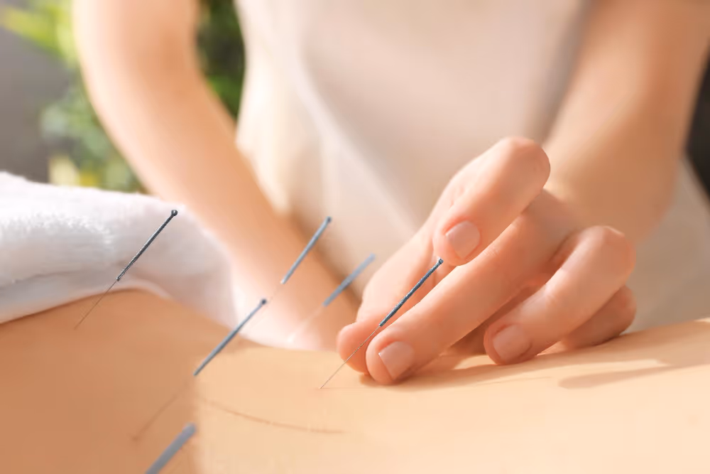 Close-up of a hand inserting acupuncture needles into a person's back during a treatment session.