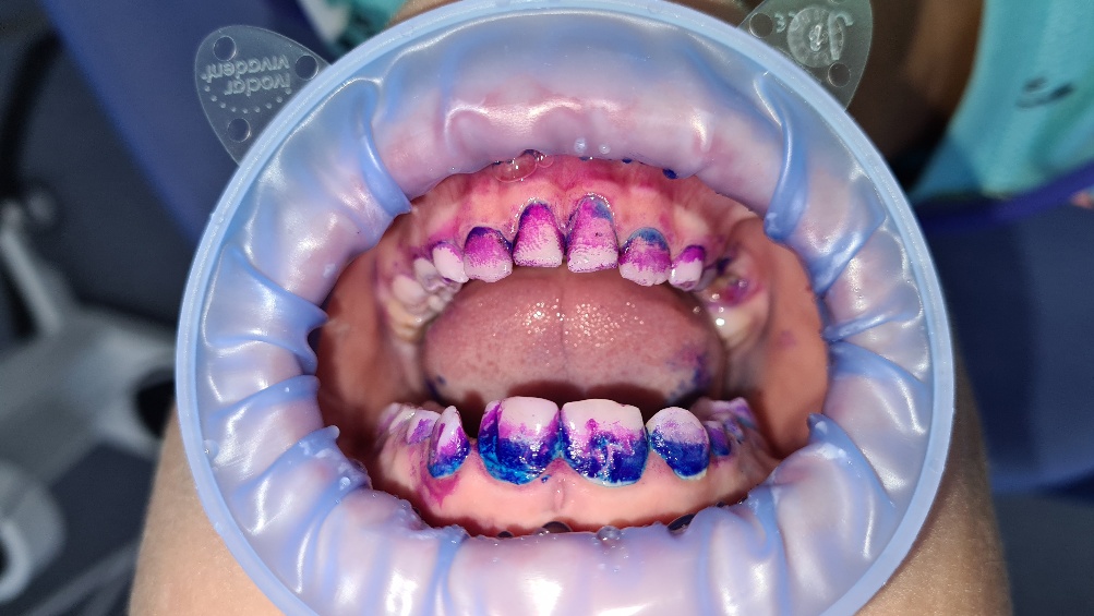 10-ročný pacient pred dentálnou hygienou