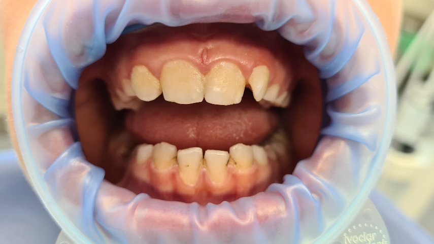 10-ročný pacient po zafarbení biofilmu