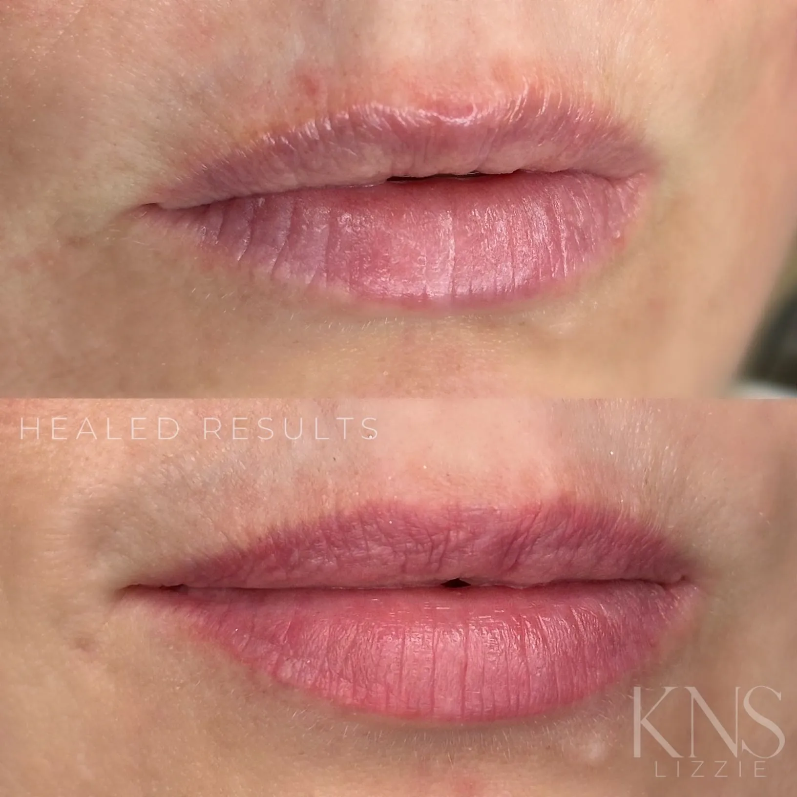 Lip neutralization and blushing before-and-after for a dark, uneven undertone — healed results at Kendra Neal Studio