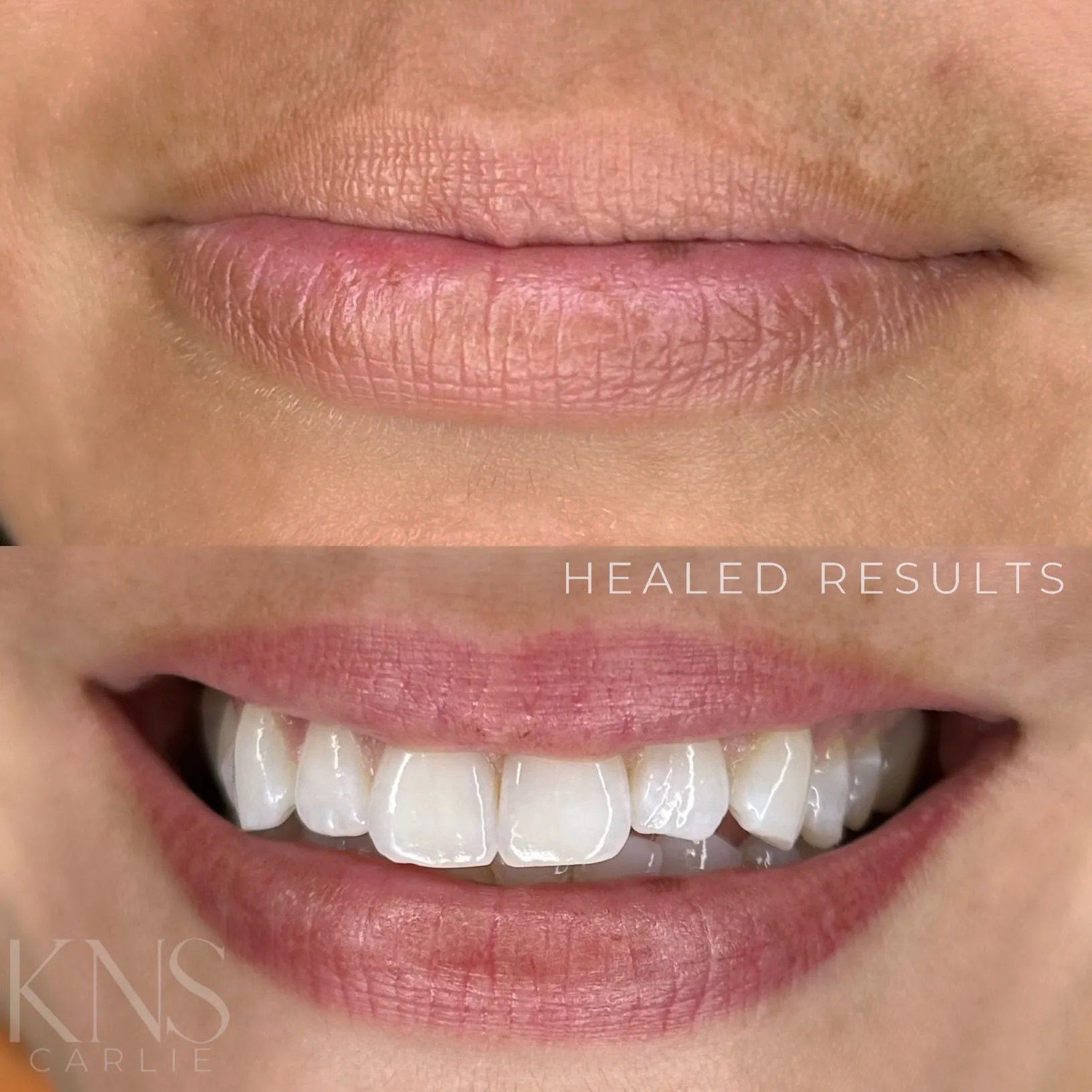 Lip blushing healed smile shot with a deep berry tone — Kendra Neal Studio