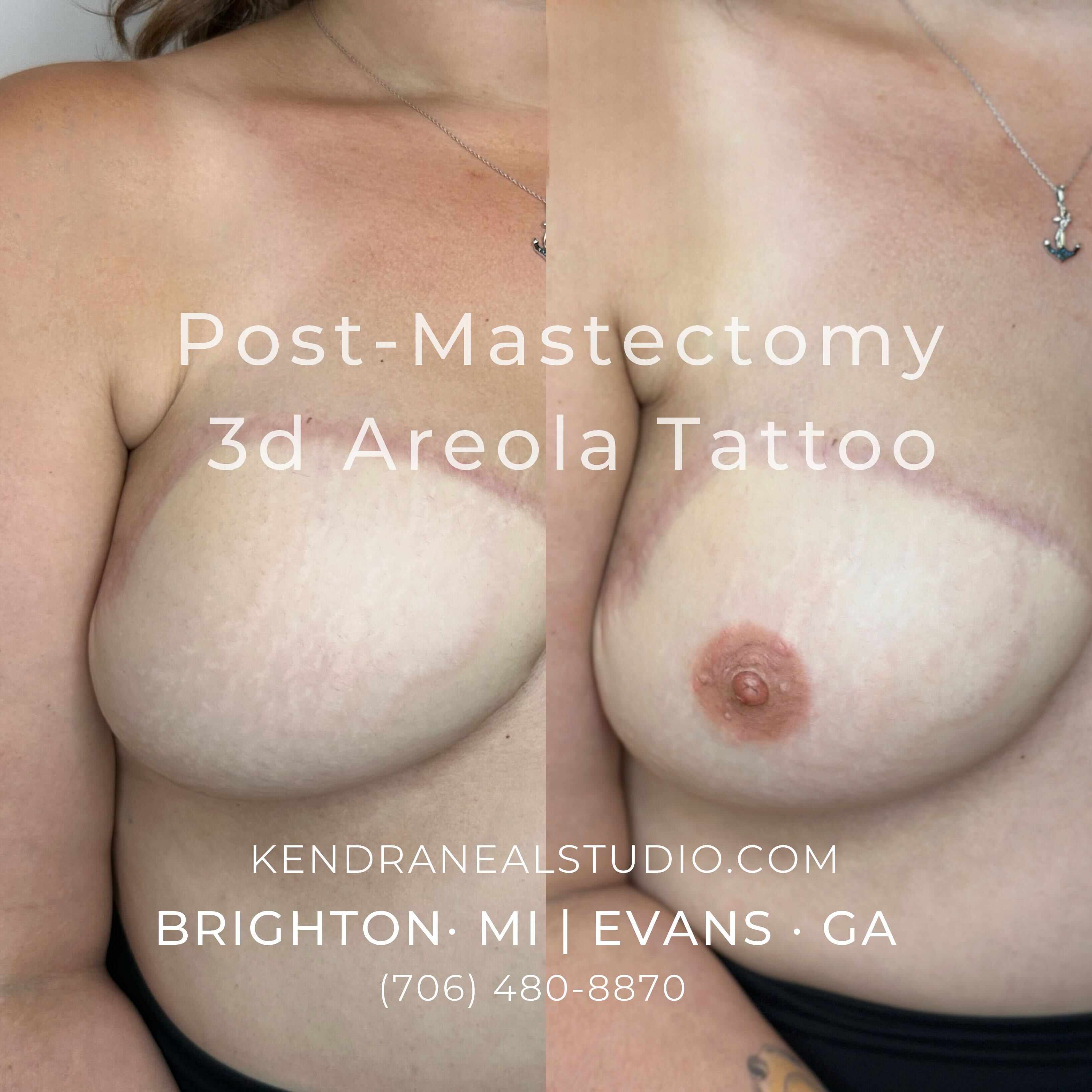 before and after of a post-mastectomy areola tattoo