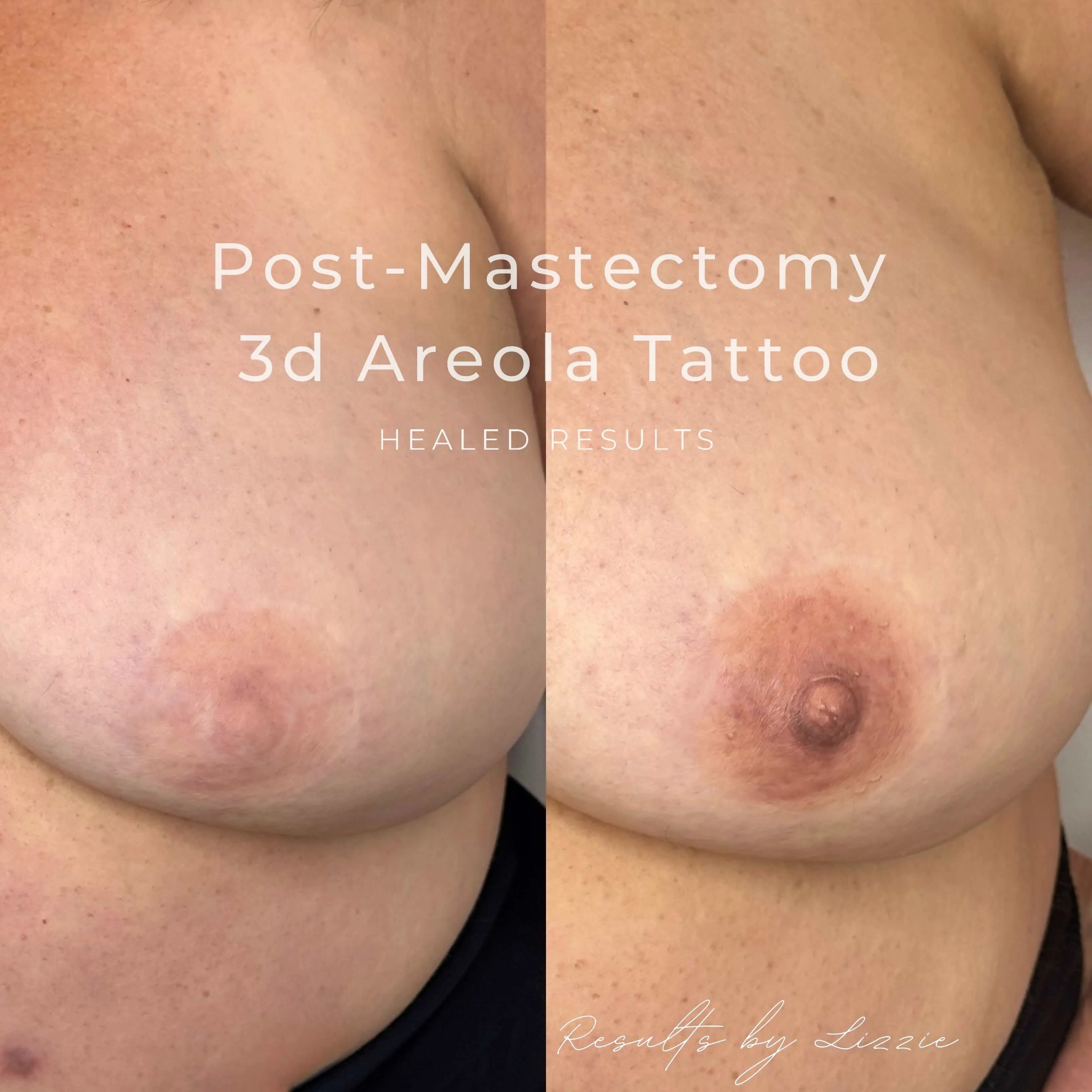 Post-mastectomy 3D areola tattoo before-and-after, single breast close-up — healed results at Kendra Neal Studio