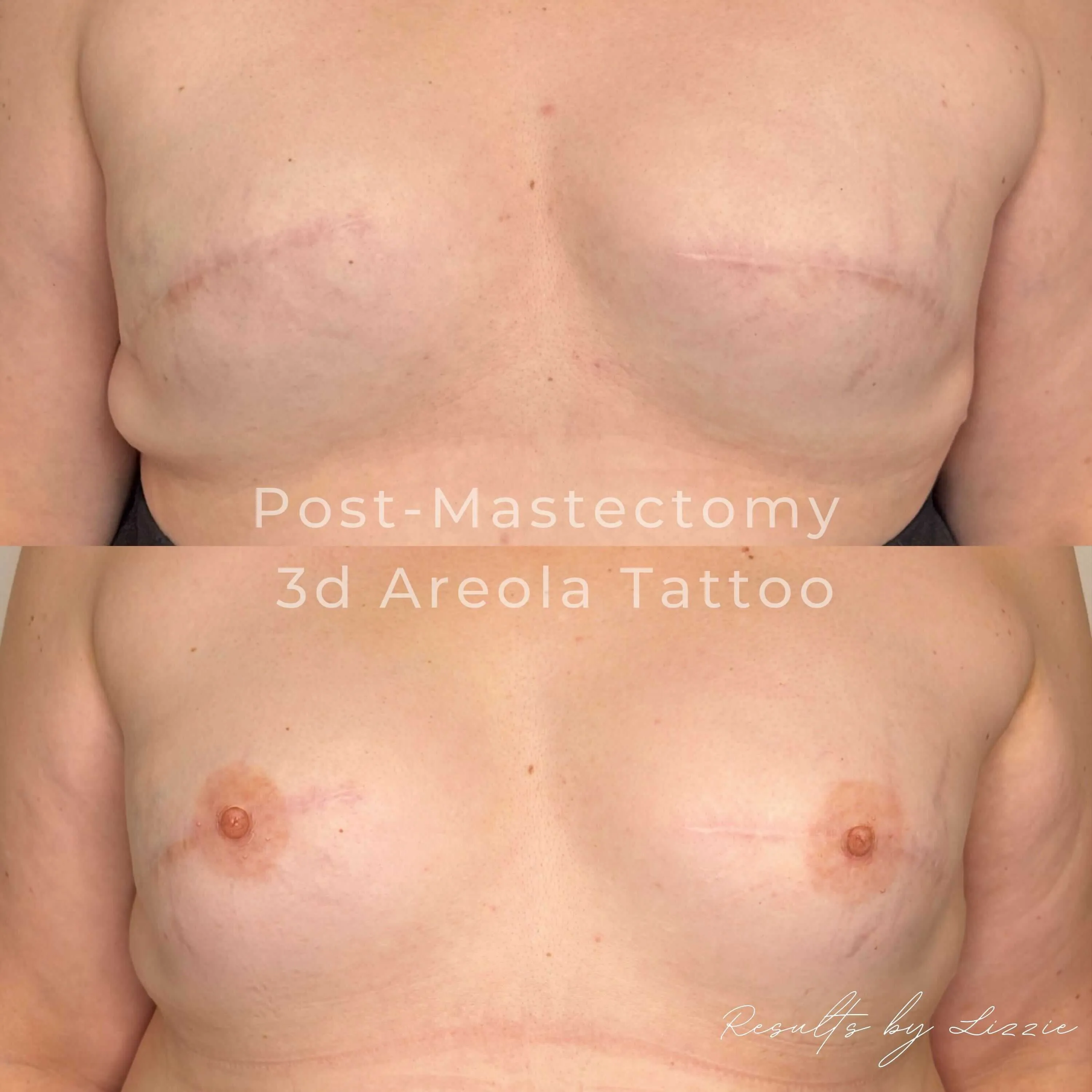 Post-mastectomy 3D areola tattoo before-and-after, both breasts — healed results at Kendra Neal Studio