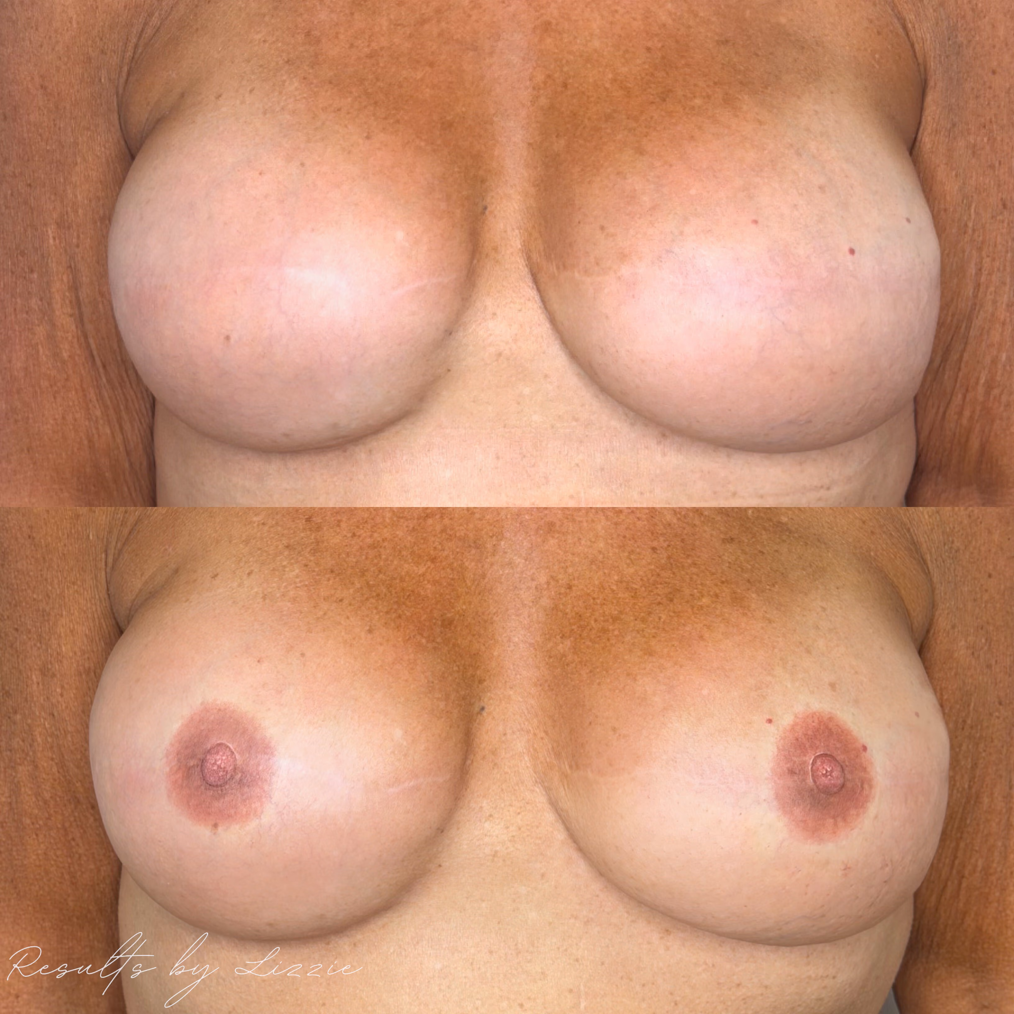 bilateral post mastectomy areola tattoo before and after