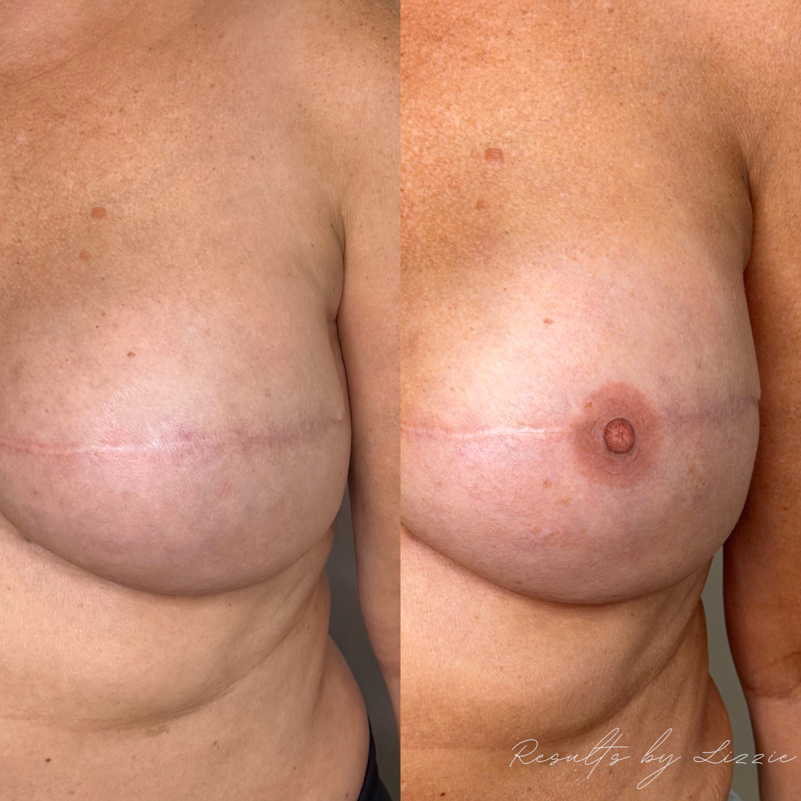 Highly detailed image of realistic areola/nipple tattoo on client with mastectomy and reconstructed breasts.