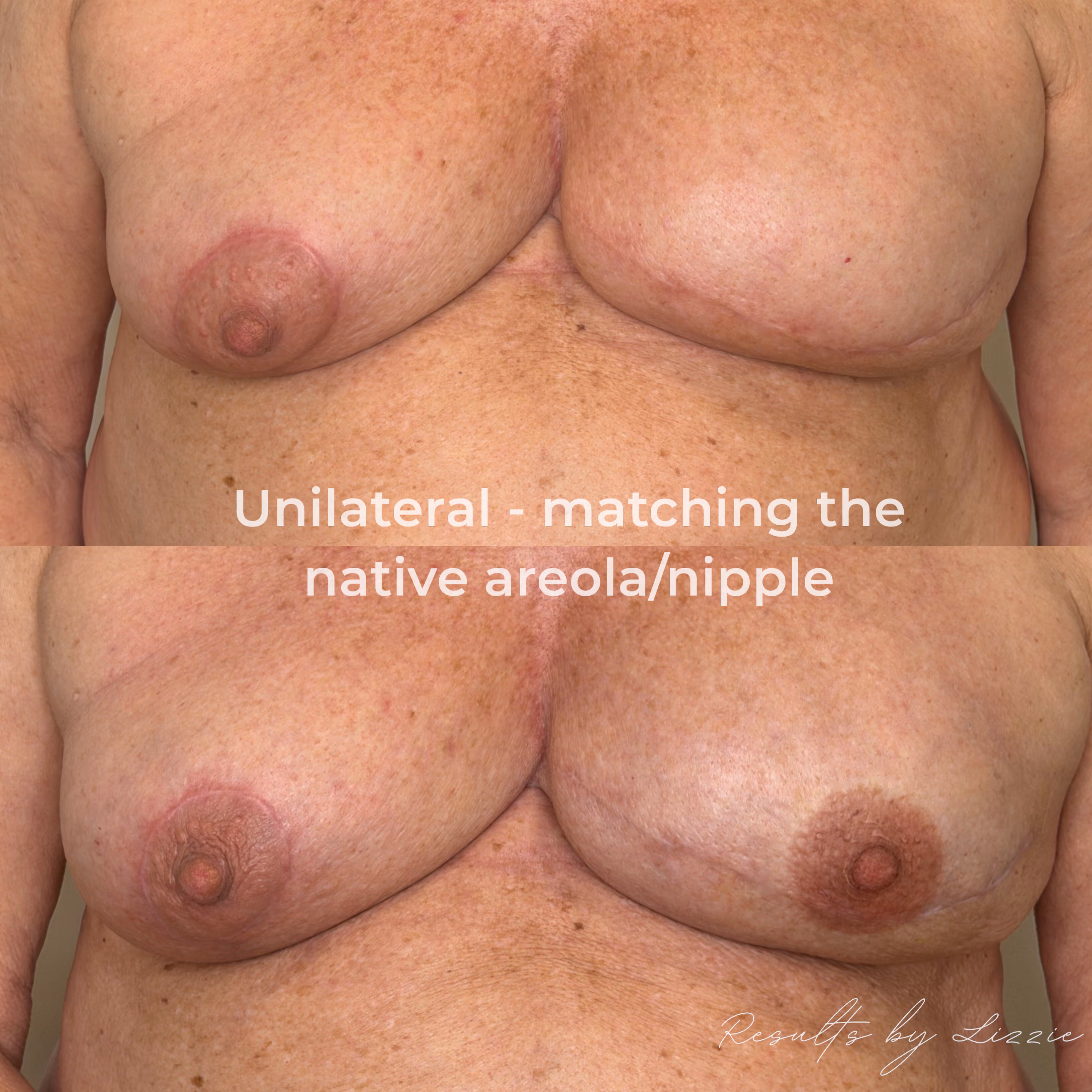 Unilateral post mastectomy areola tattoo matching native nipple and areola