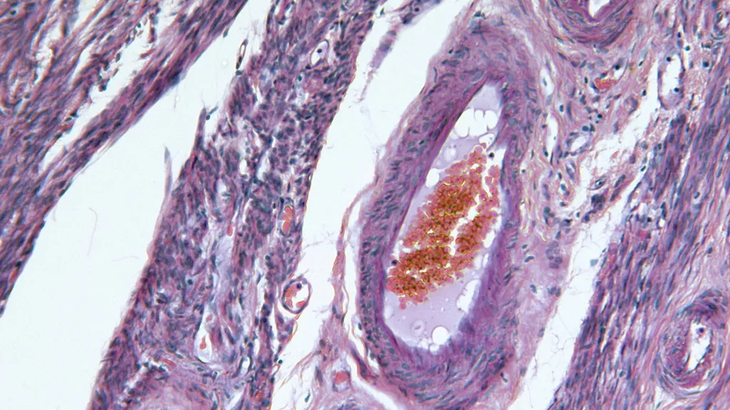 Диагностика эндометрита