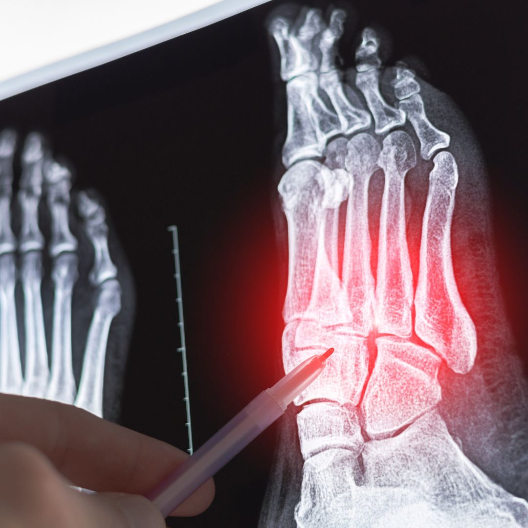 What is the Lisfranc Joint 