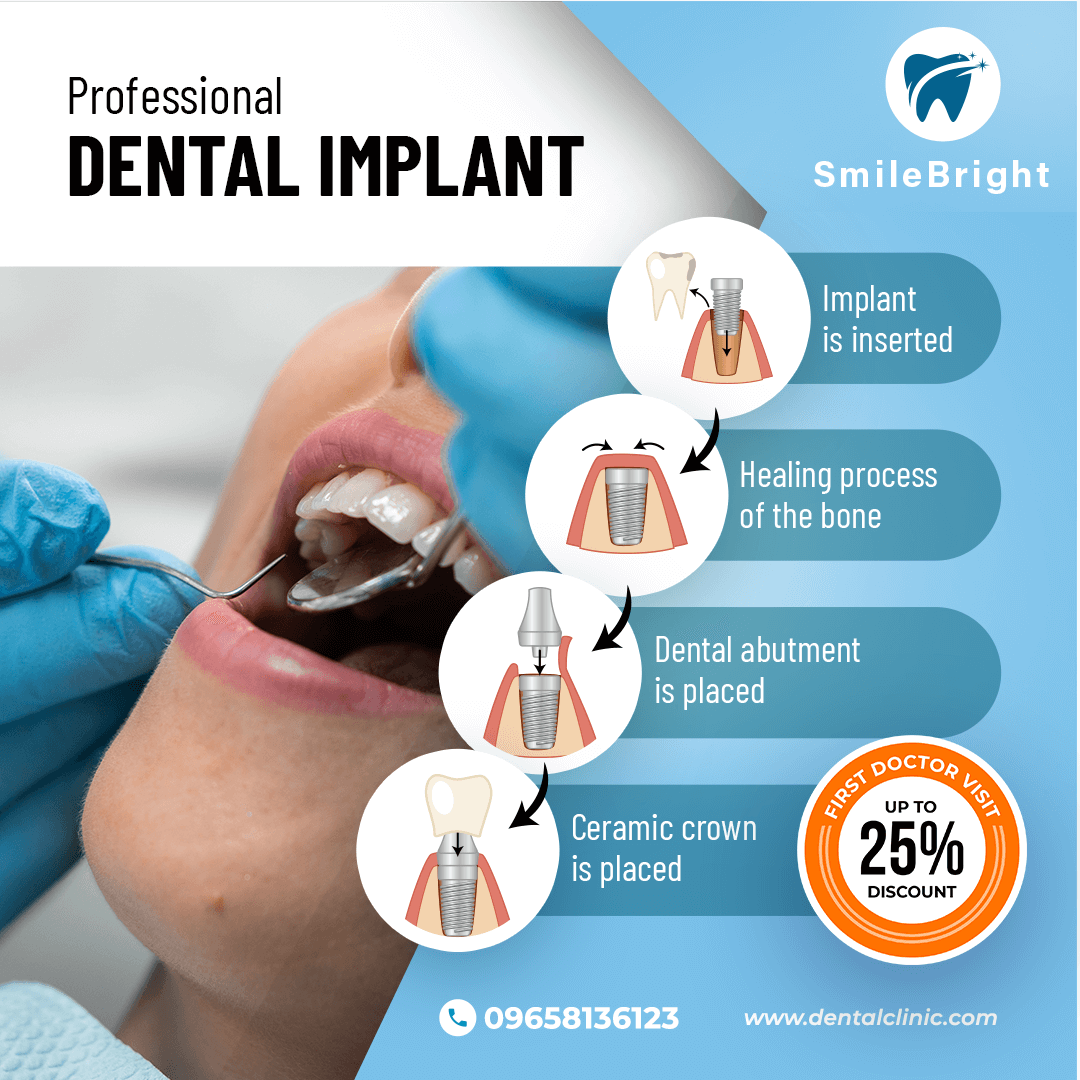Dental Implant