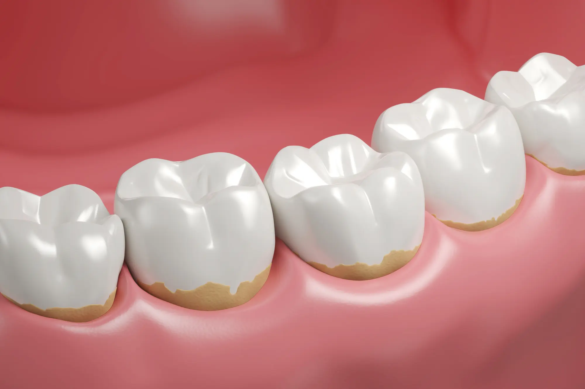 Wesley Chapel, FL Dental Crowns 