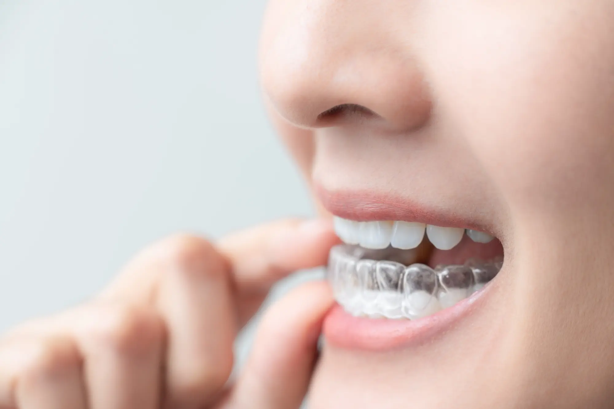 Does Invisalign Offer an Authentic Transition to Straight Teeth?