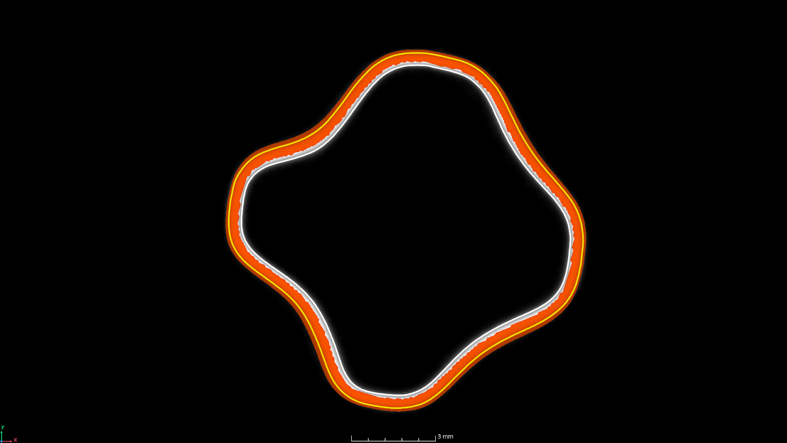 Exterior surface area using VGL software for medical device
