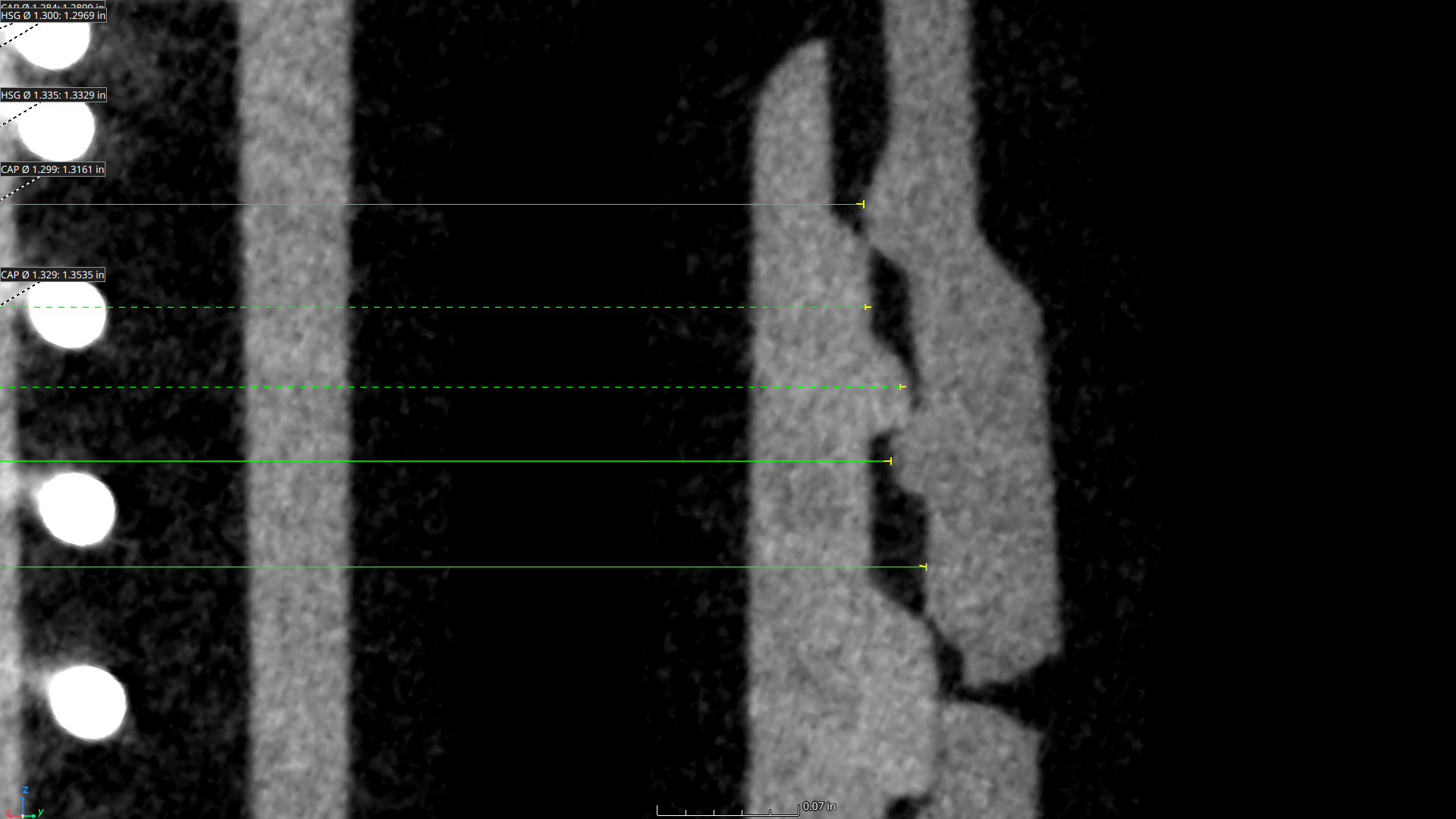 CT scan showing thread measurements