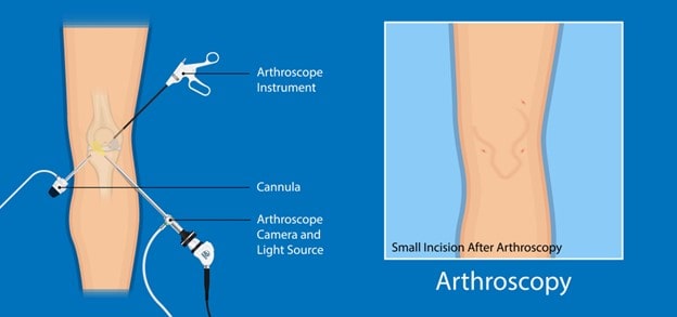 How Is Atlanta Knee Arthroscopy Performed?