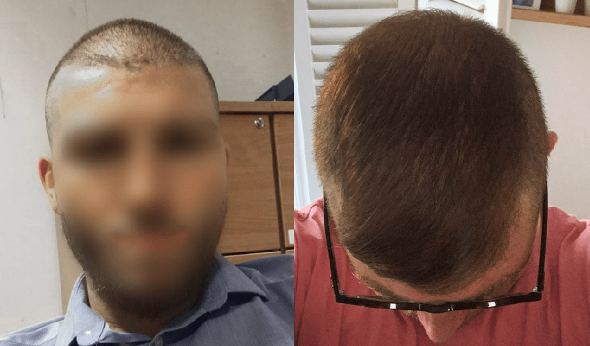 Michael-before-after