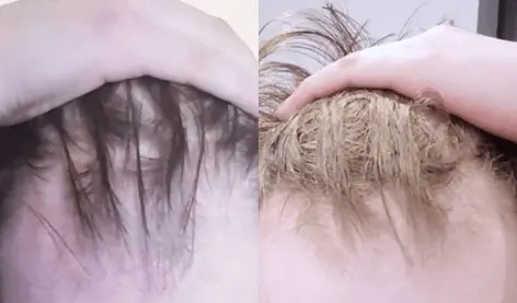 Manual hair loss before after