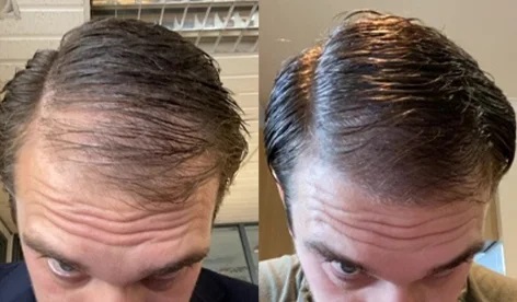Manual hair loss before after