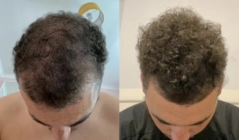 Manual hair loss before after