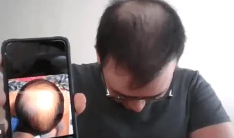 Manual hair loss before after