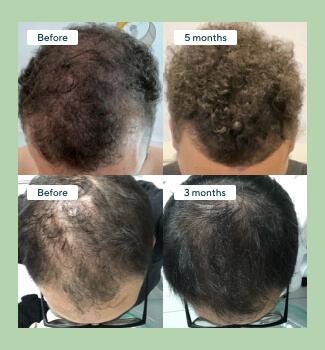 Hair loss tablets