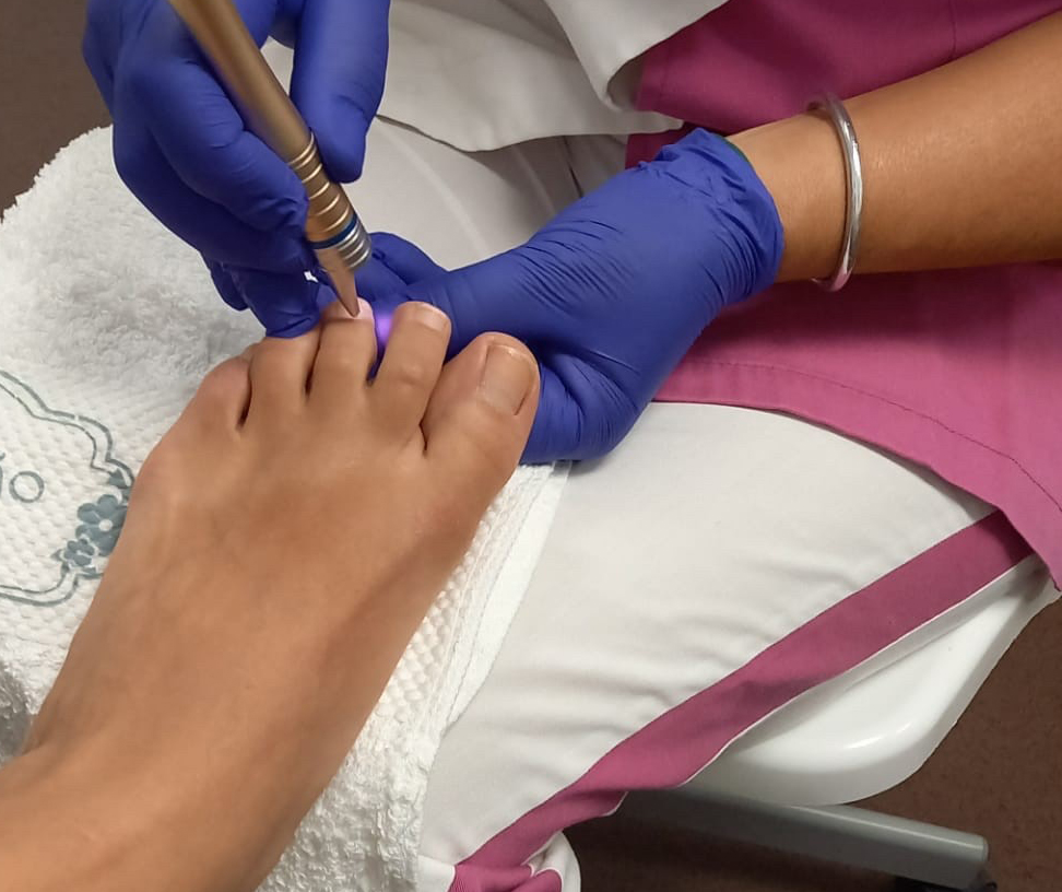 Laser de fungos de unhas