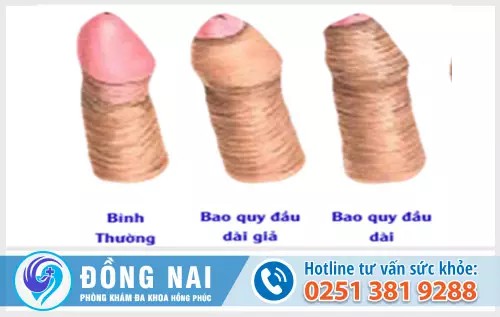 Dài bao quy đầu là bệnh gì?