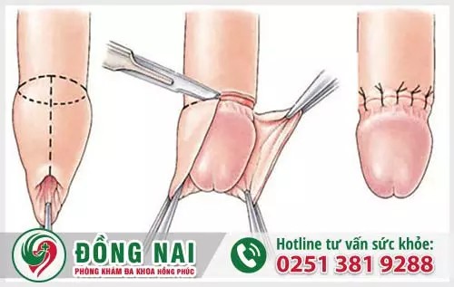 Phẫu thuật cắt bao quy đầu