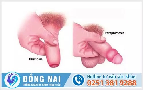 Hẹp dài bao quy đầu là bệnh nam khoa gì?
