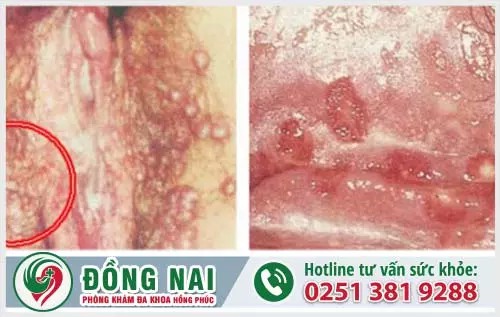 Hình ảnh thực tế bệnh mụn rộp sinh dục