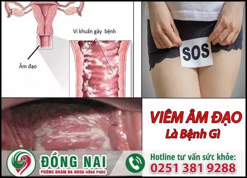 Bệnh viêm âm đạo
