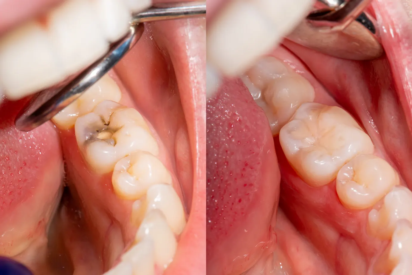 veneers