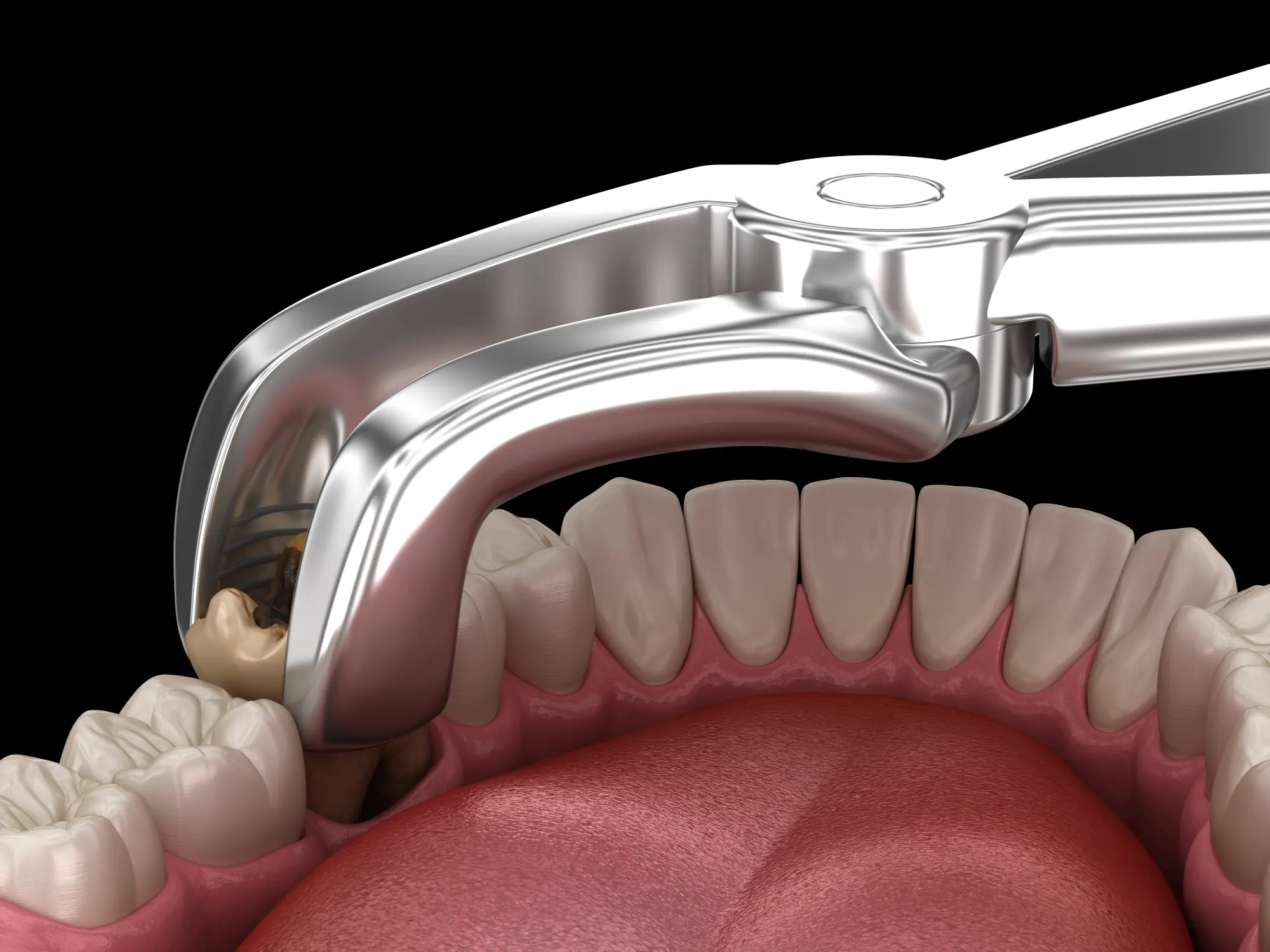 Tooth Extraction vs. Root Canal: Making the Right Choice for Your Dental Health