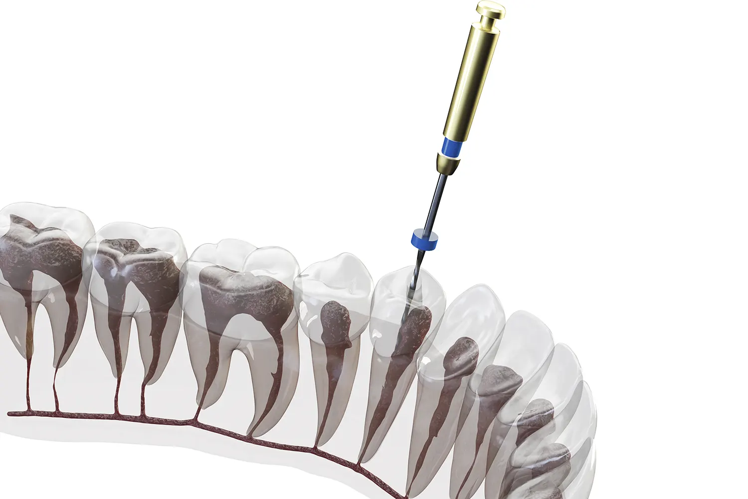 Can a Root Canal Be Done Through a Crown?