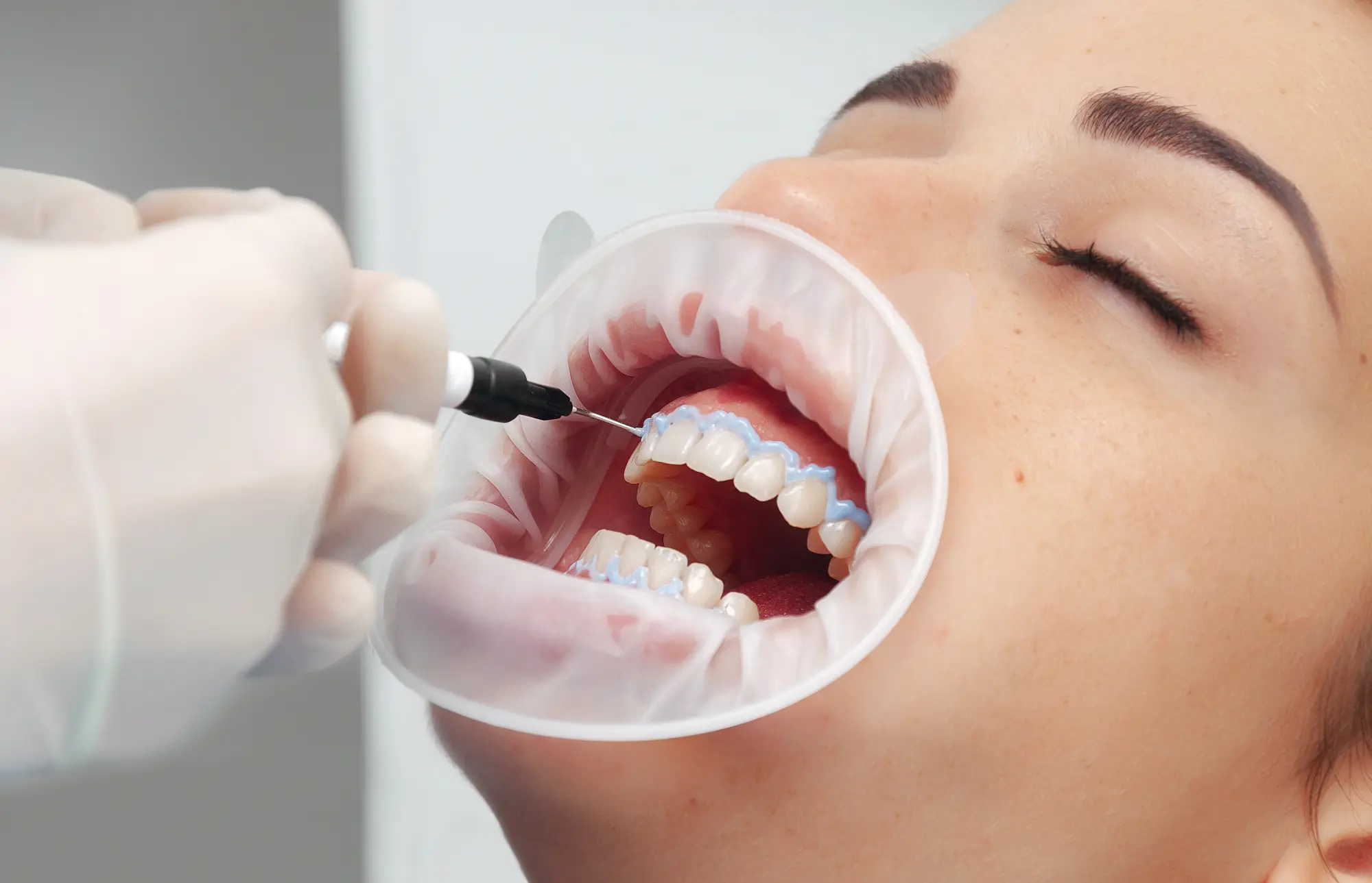 Can You Whiten Veneers?